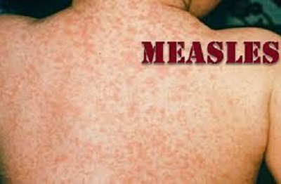 measles