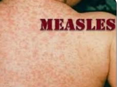 Measles